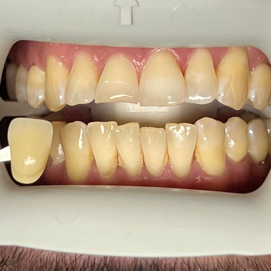 Blanqueamiento dental: antes