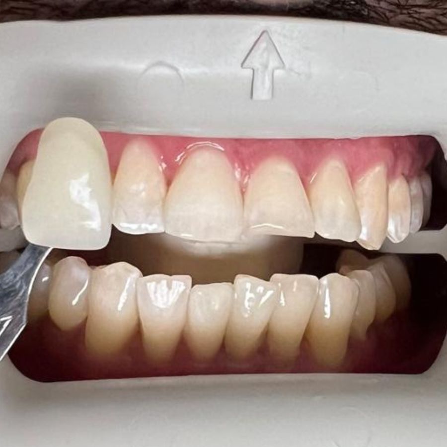 Blanqueamiento dental: después