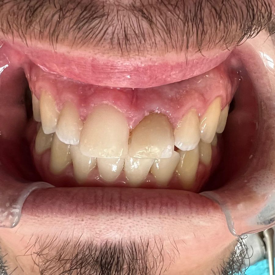 Corona en dientes frontales: antes