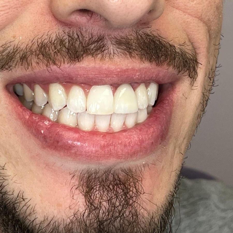 Corona en dientes frontales: después