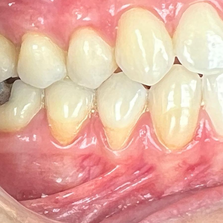 Injerto gingival: antes