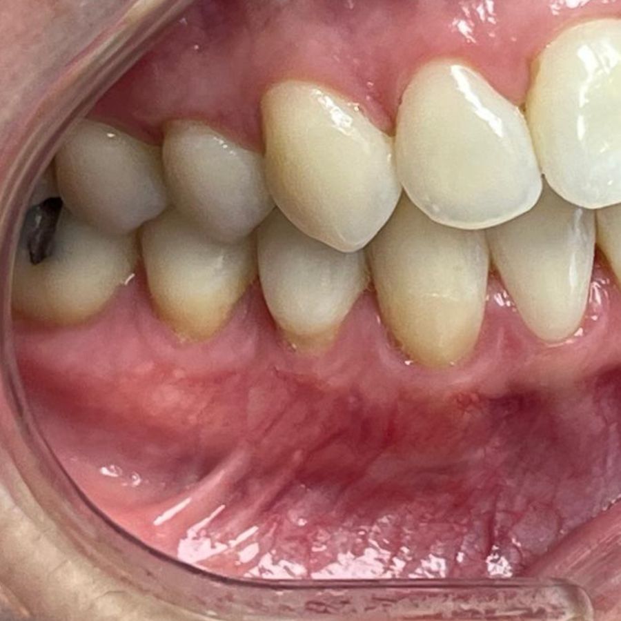 Injerto gingival: después